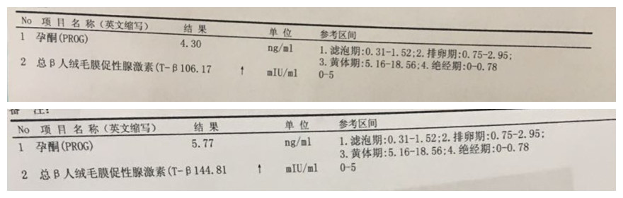 2次宫外孕的心酸,左右两侧都有过宫外孕的经历
