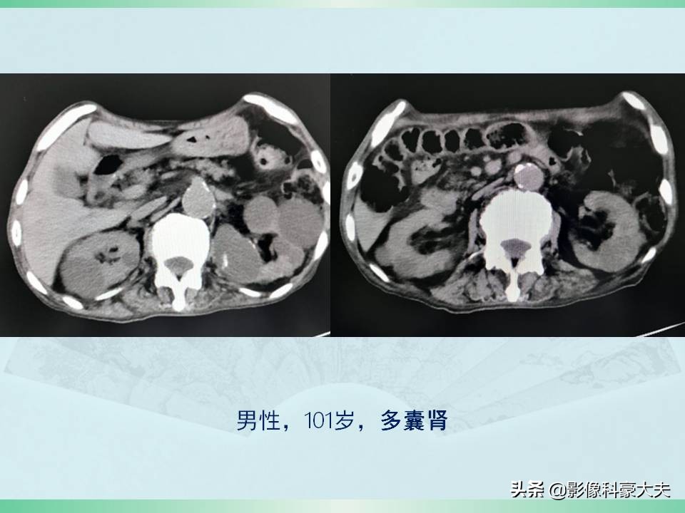 得了尿毒症又得了癌症怎么办,尿毒症为什么发病大多是年轻人呢