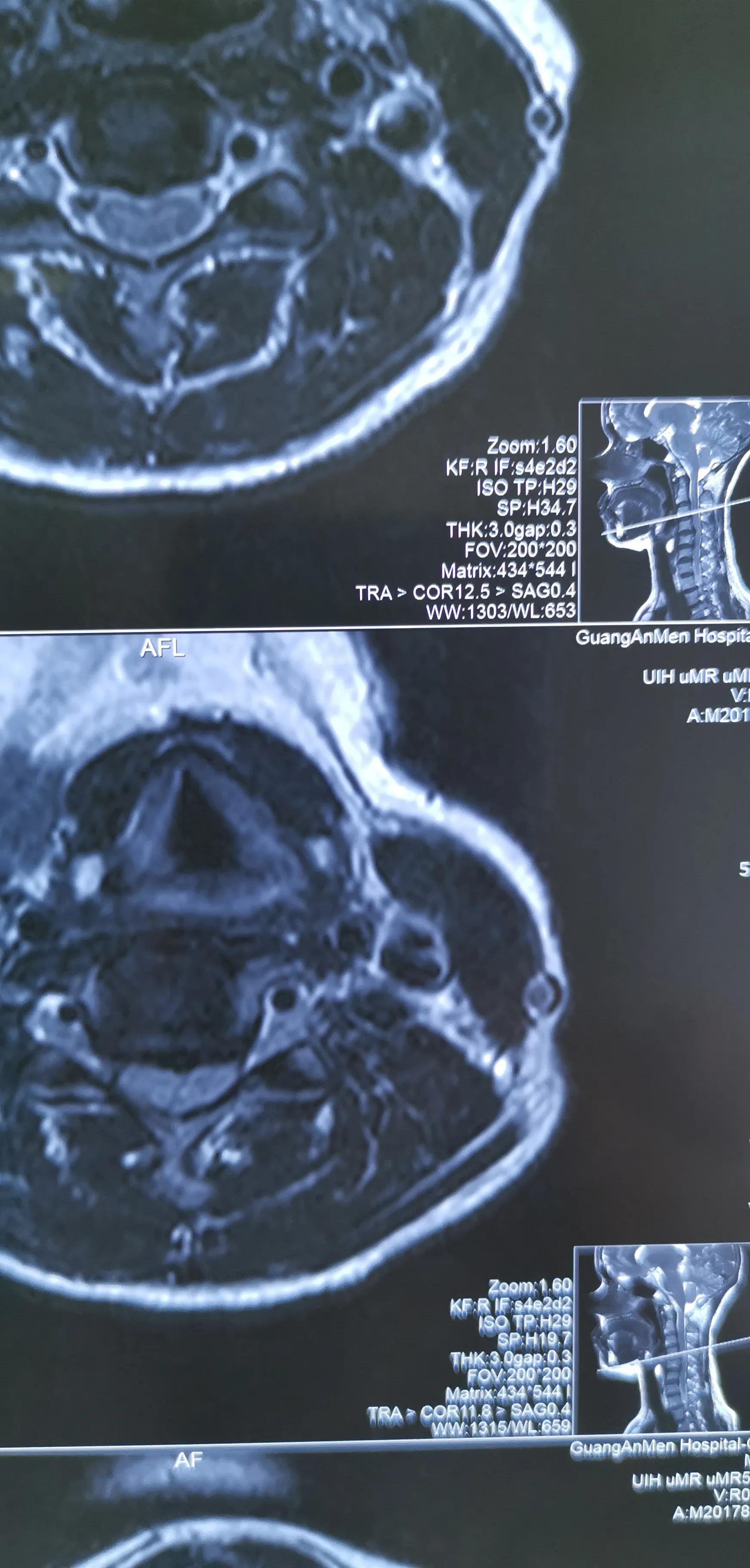 颈椎椎间盘轻度切除,颈椎全切除