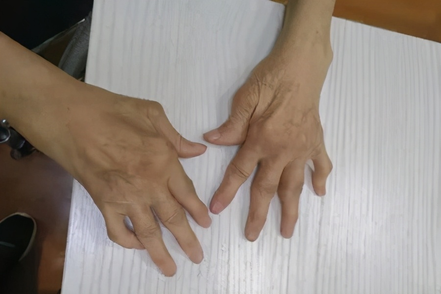 类风湿关节炎如何能把激素减停,治疗类风湿消除炎症的最佳办法