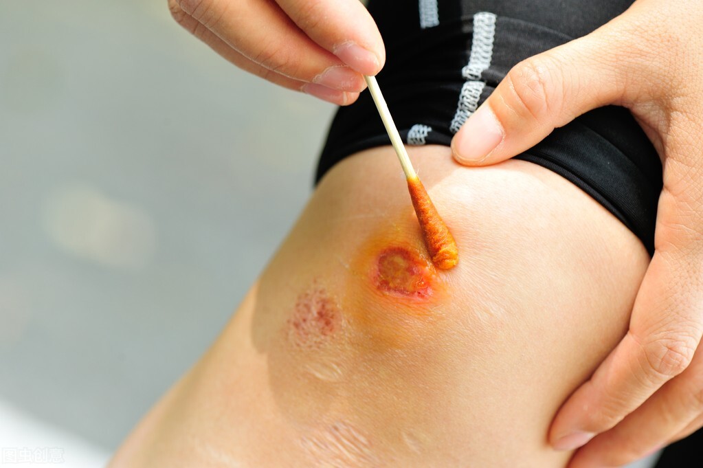 伤口酒精和碘伏哪个消毒效果好,皮肤消毒用酒精和碘伏区别