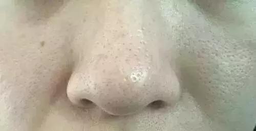 改善毛孔粗大油腻暗沉的方法,如何拯救毛孔粗大油腻的脸