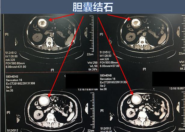 有胆结石胆囊处隐隐作痛怎么解决,胆囊小结石会引起哪些不适