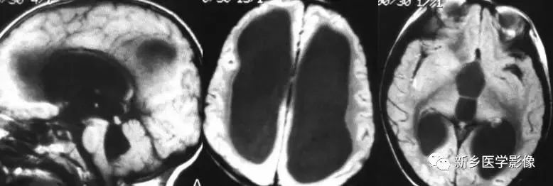 影像学脑室扩大,脑室显大怎么理解