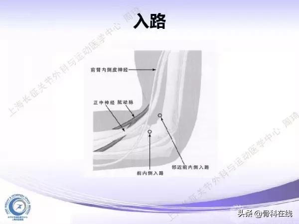 肘关节镜手术后引流,肘关节镜微创手术