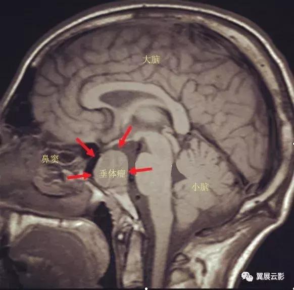 脑脓肿增强扫描是环形强化吗,脑部脓肿