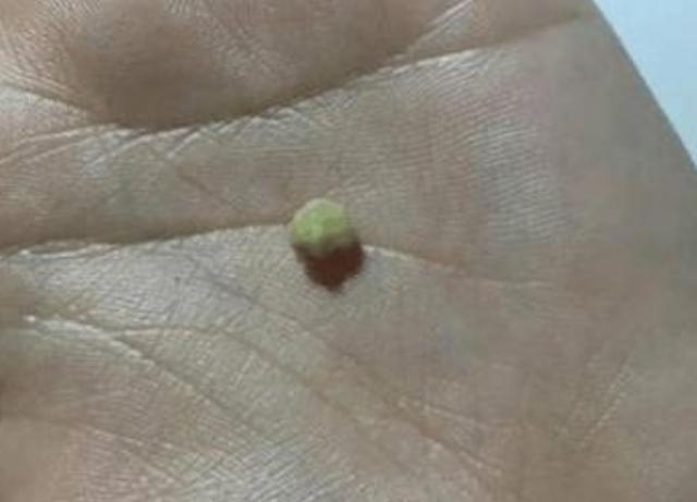 孩子口臭被学生孤立怎么办,孩子口臭被同学嫌弃