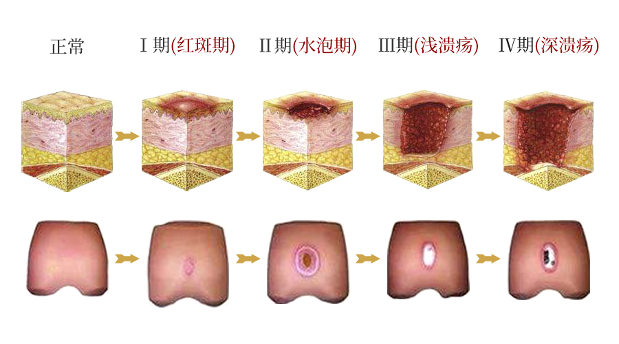 骨折褥疮如何恢复,骨折老人出现褥疮了怎么办