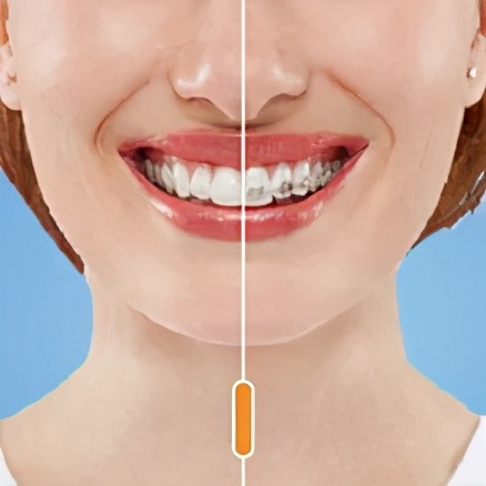 矫正牙多久能戴上牙套,矫正牙需要戴牙套一辈子吗