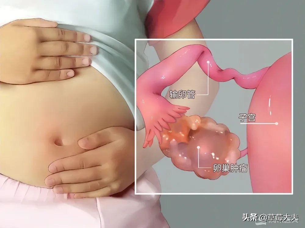 女娃腹痛,卵巢囊肿腹痛要做手术么