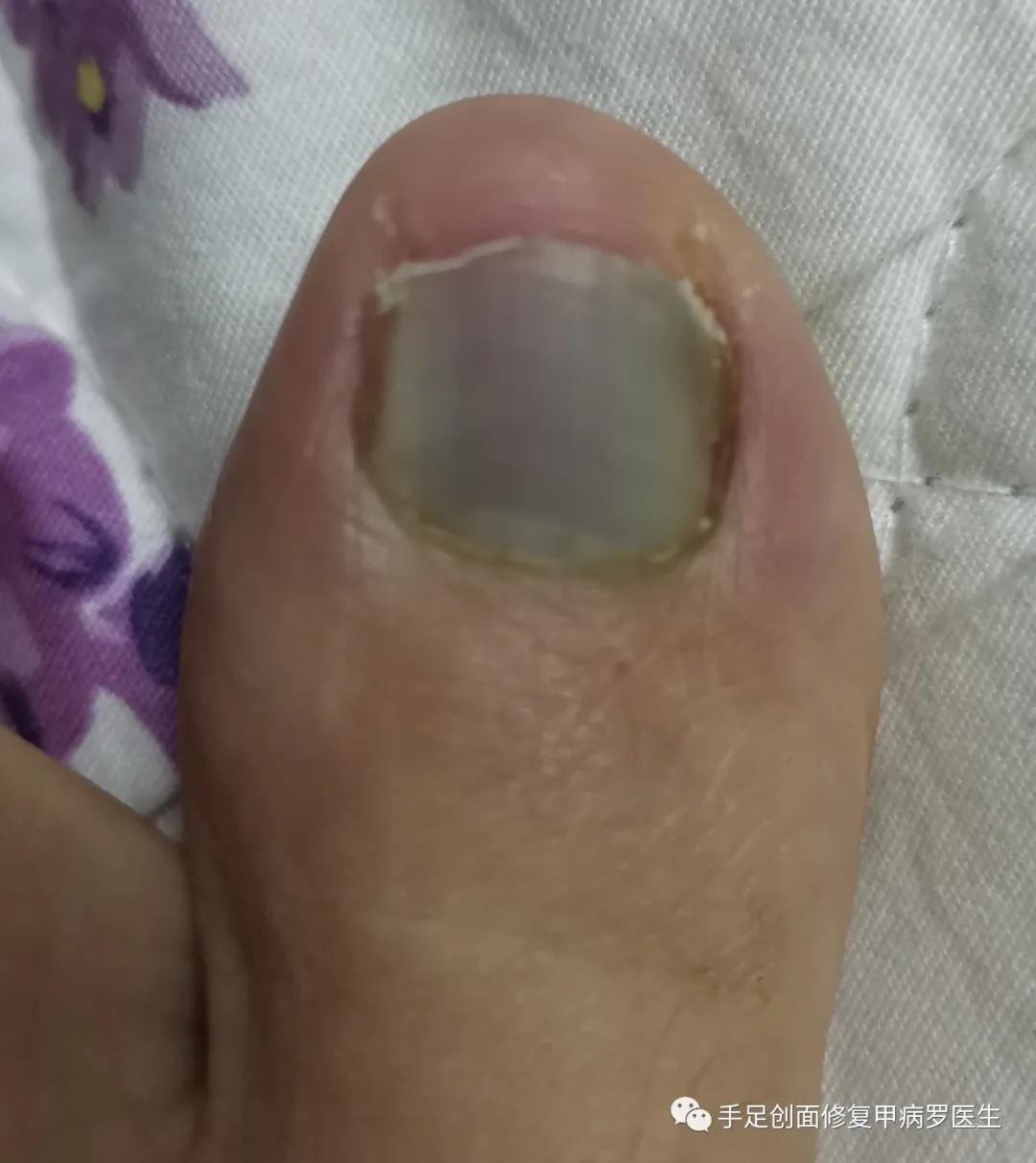 甲下积血怎么处理,甲下积血不排血会胀痛吗