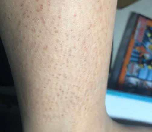 皮肤干燥缺水用什么保湿水最好,皮肤干燥缺水用什么来补水