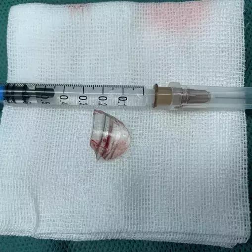 儿童误吞玻璃死亡,孩子误吞了碎玻璃怎么办