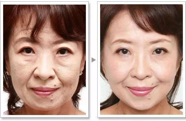 抗皱纹抗老小妙招,30岁后的面部抗老思路