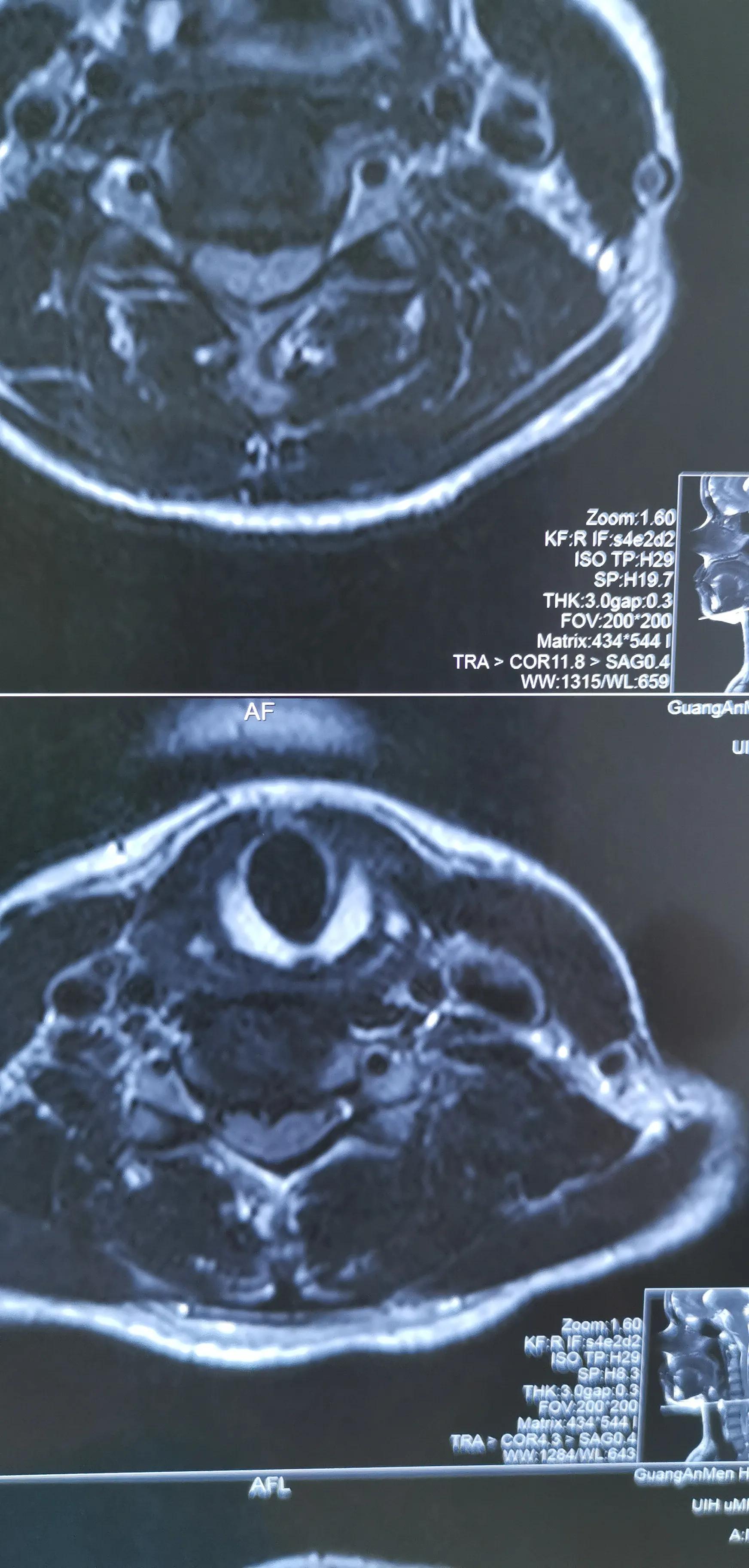 颈椎椎间盘轻度切除,颈椎全切除
