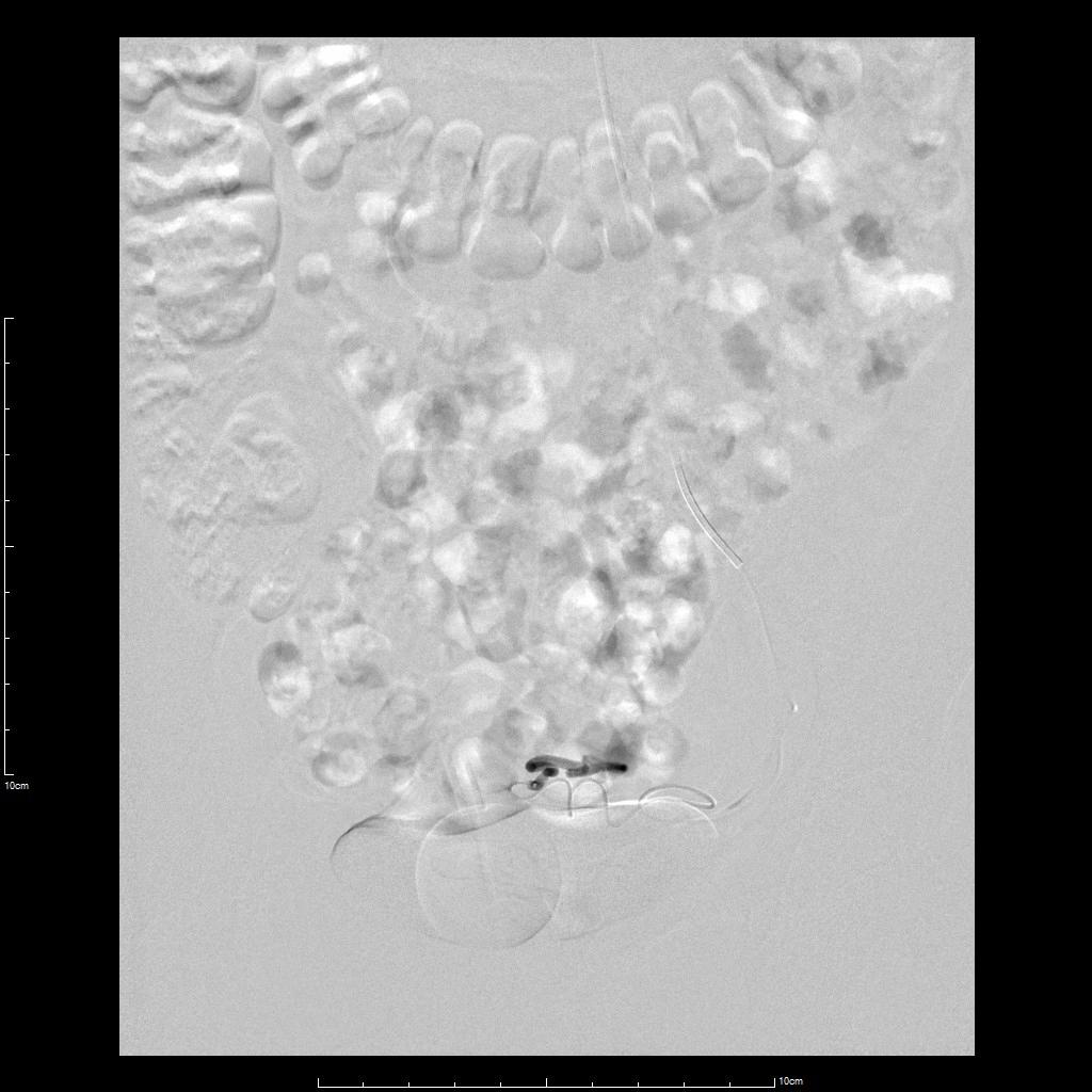 子宫腺肌症介入栓塞全国哪里好,子宫腺肌症介入栓塞治疗报销吗