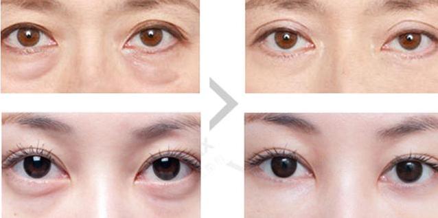 淡化眼纹黑眼圈的方法,女人眼睛看起来很显老要怎样调理