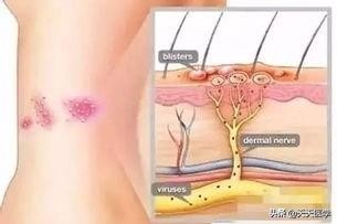 带状疱疹治愈后两年还有神经痛吗,带状疱疹后遗神经痛最新疗法