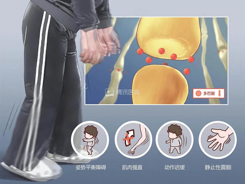 神经外科手术治疗帕金森综合症,神经外科治疗帕金森