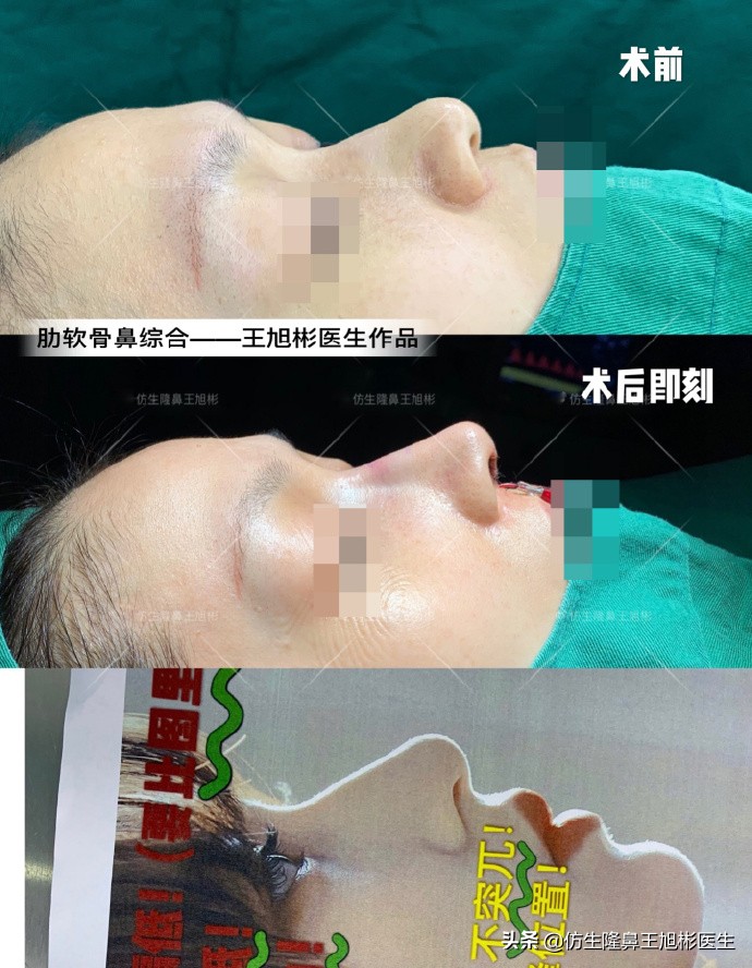 大鼻头能做直鼻微翘吗,可以只做鼻头缩小术吗