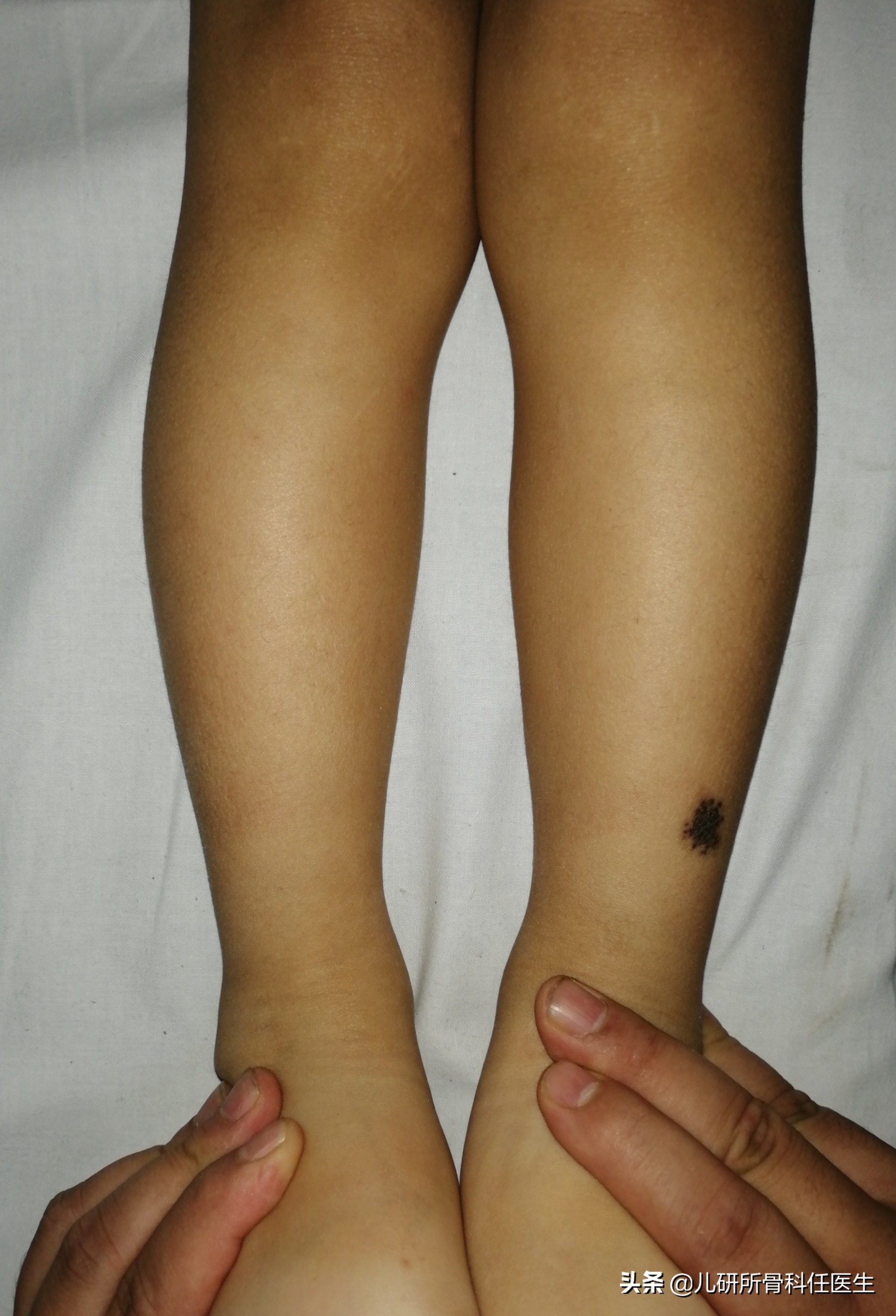 孩子走路太早对腿有什么伤害,宝宝站立早会罗圈腿吗