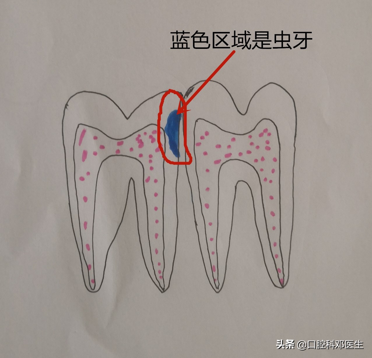 上排虫牙补牙全过程,虫牙补牙疼怎么办