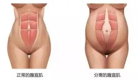 腹部训练腹直肌分离腰痛,腹直肌分离会引起腰痛吗