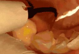 保定牙博士冷光美白团购,保定牙博士拔牙团购