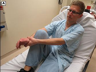 肩脱臼了怎么恢复,肩脱臼怎么彻底恢复