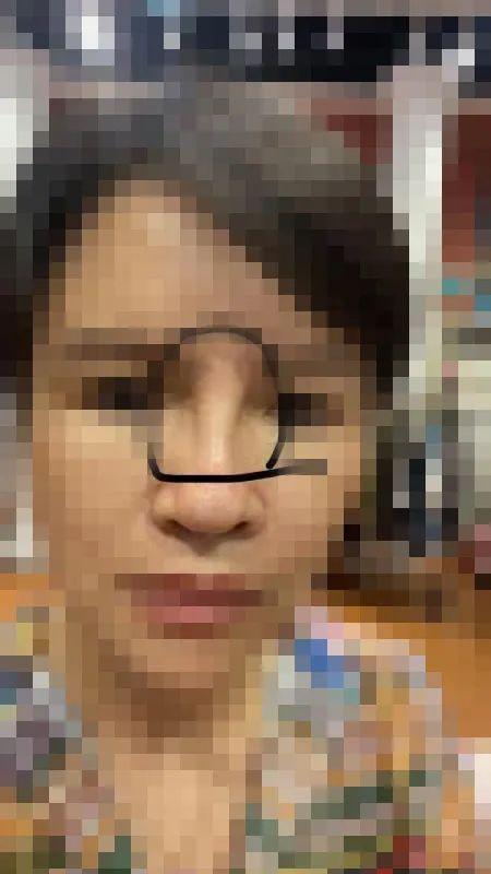 “你用手掰回来啊！”深圳女子整容歪鼻，医生竟让她自行掰正