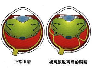 视网膜脱落复位不完全怎么办,孔源性视网膜脱落能恢复视力吗