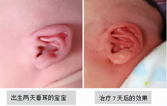 宝宝耳廓形态畸形怎么办,新生儿耳廓畸形治疗费用