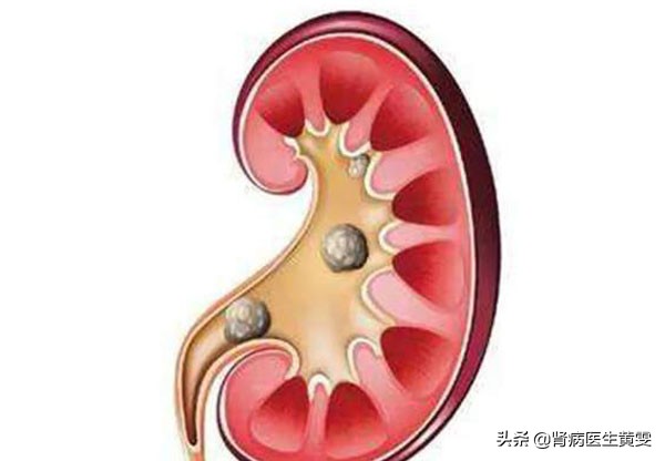 女性肾积水腰痛会影响小腿酸胀吗,肾积水腰疼怎么治疗需要住院吗