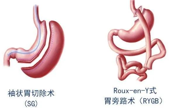 切胃减肥手术后遗症有哪些,切胃的人后来都怎样了