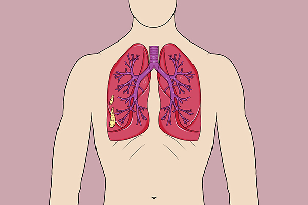 咳痰咳出的痰分几类,咳痰颜色有什么区别