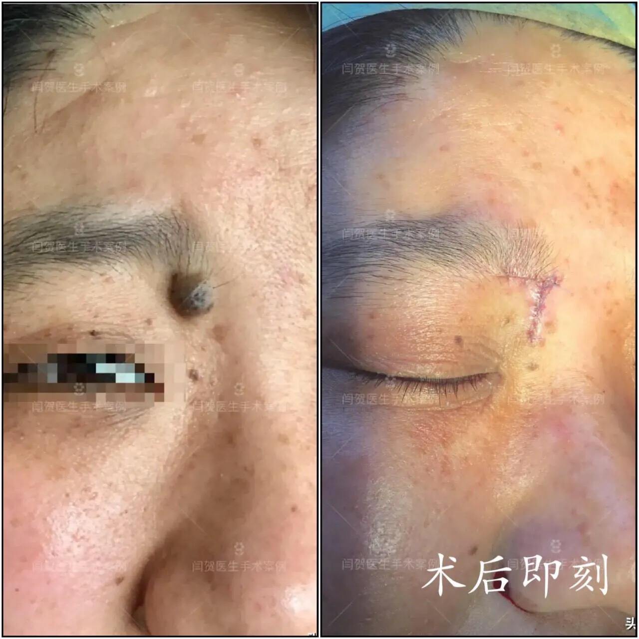 脚底有痣激光还是手术切除,黑色素痣手术切除还是激光去除好