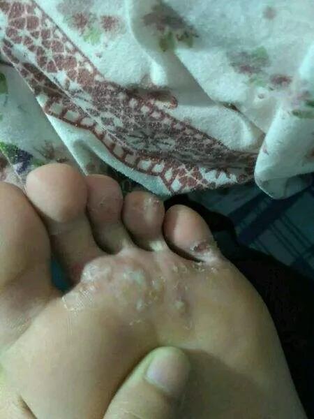 痒痒病怎么治,痒痒用什么中草药止痒最好