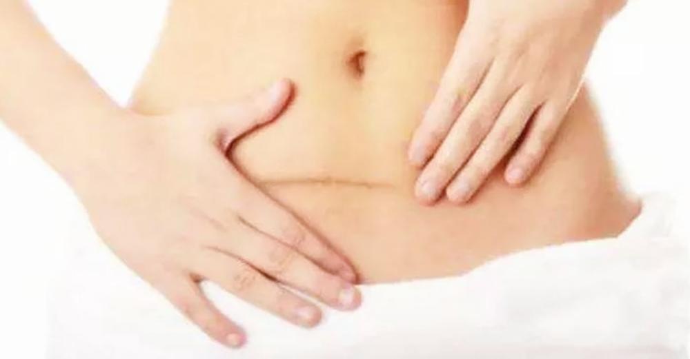 为什么剖腹产伤口会疤痕增生,剖腹产伤口疤痕变化