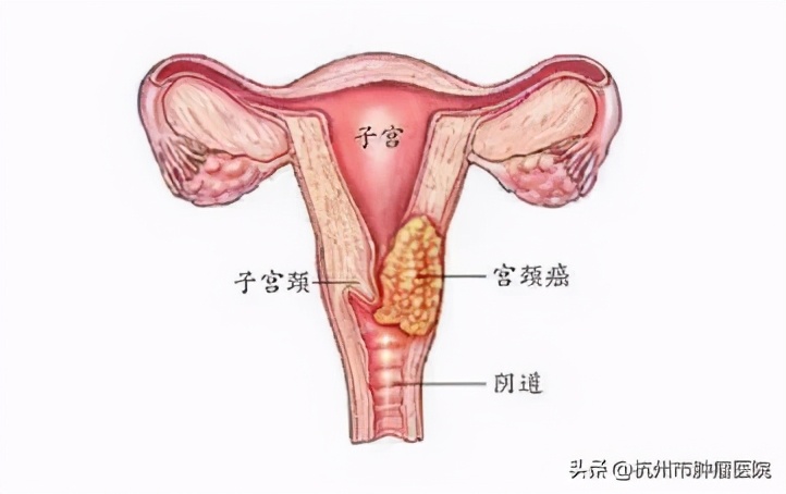 预防宫颈癌最有效的方法是打疫苗,宫颈癌疫苗可以有效预防宫颈癌吗