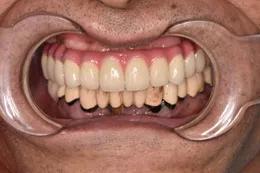 佛山种植牙齿全过程,南京牙齿种植案例分享