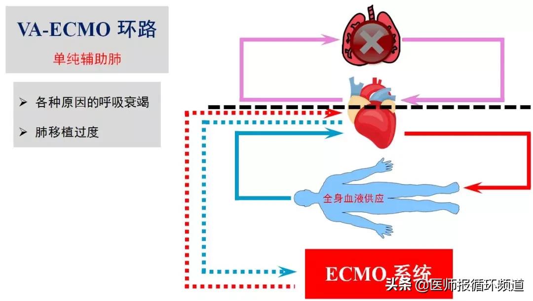 ecmo加重心衰,心衰上ecmo使用什么模式
