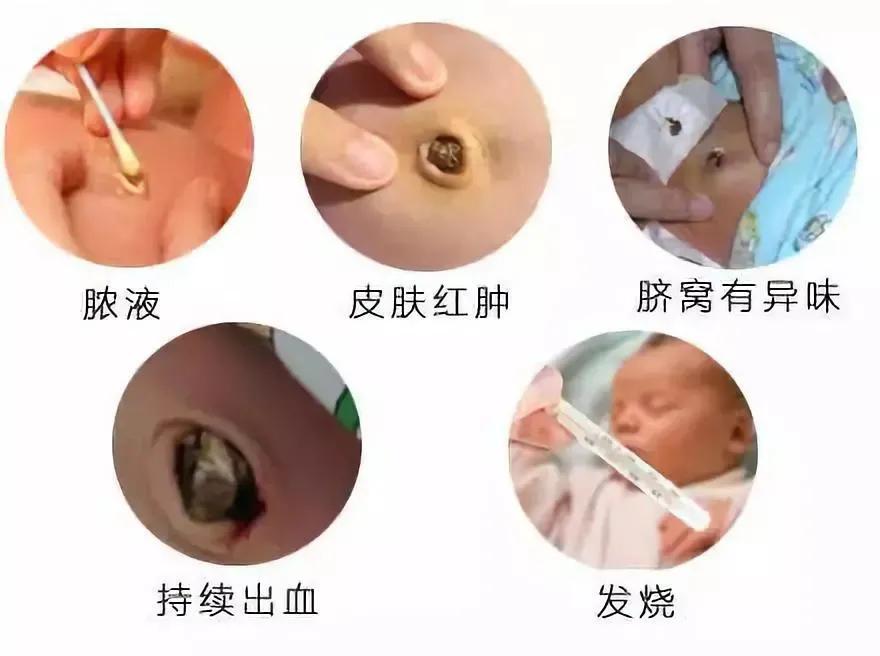 脐部护理的介绍,新生儿脐部护理