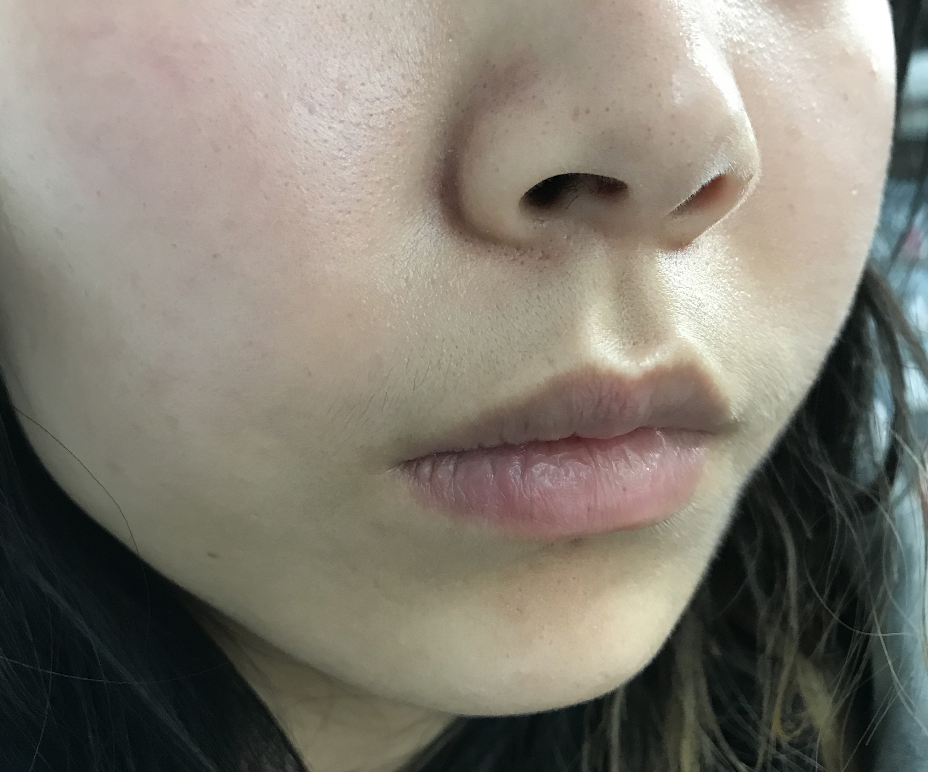 医美收毛孔价格表,医美收毛孔效果