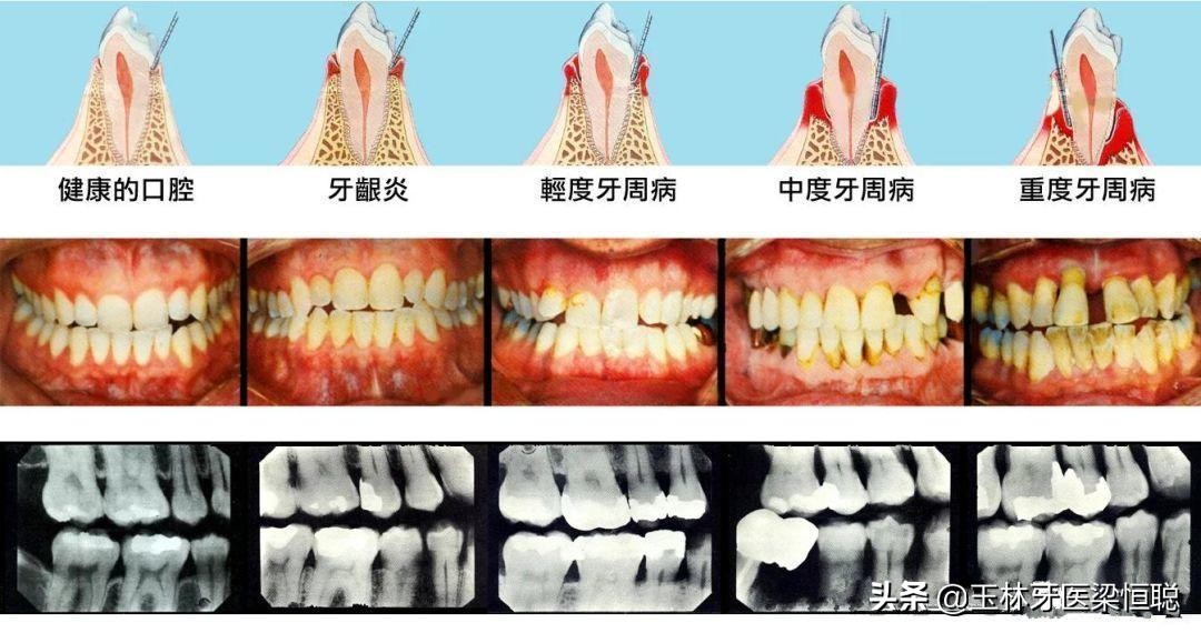 什么是牙周炎的临床表现,什么是牙周炎用什么药见效