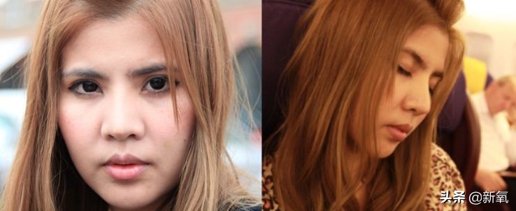 18岁土肥圆豪掷800万全身整形，鼻子6次大整假体穿出，效果却超美