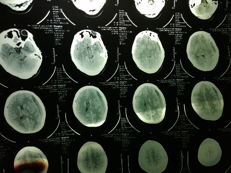 安医二附院生娃后老婆颅内硬膜下血肿伴视力模糊该找谁!