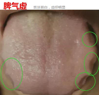 脾气虚和脾阳虚脾虚湿盛的区别,脾虚百病生脾虚有哪些表现