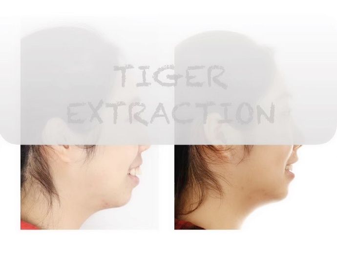 牙齿矫正南京哪家医院比较好,牙齿代偿性矫正