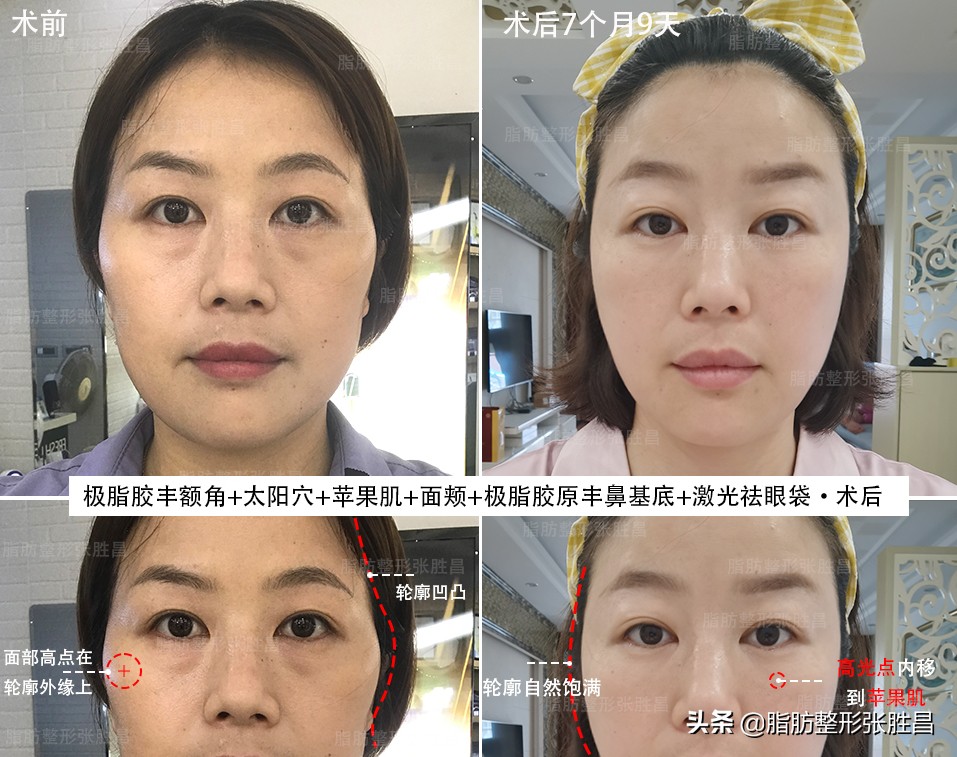 做脂肪填充面部以后变胖了,做脂肪面部填充会变美吗