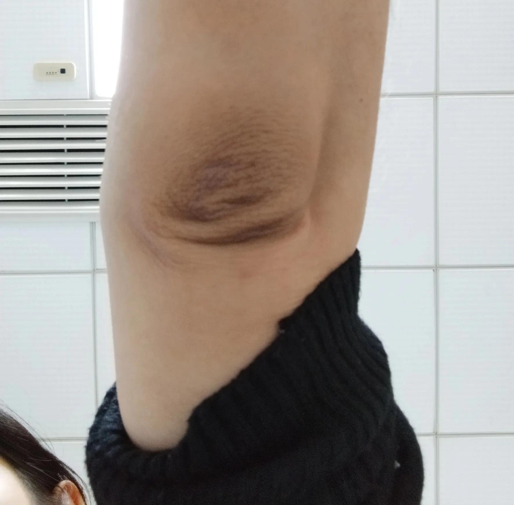 10天内变白的方法,手肘关节黑怎么变白起疙瘩